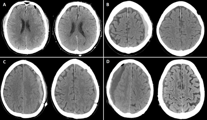 Illustrative cases of each preprocedural CSDH maximal thickness group. (A) Noncontrast head CT image (left) shows a maximal hematoma thickness of 9 mm (group 1, <10 mm) in a 77-year-old man who underwent middle meningeal artery embolization (MMAE) concurrently with left-sided craniotomy for hematoma evacuation. Follow-up noncontrast head CT image (right) at 4 months shows complete resolution of the hematoma. (B) Noncontrast head CT image (left) shows a maximal hematoma thickness of 11.6 mm (group 2, 10 mm to <15 mm) in an 80-year-old man who underwent MMAE following recurrence after a prior left-sided burr hole procedure (3 months earlier). Follow-up noncontrast head CT image (right) at 9 weeks shows complete resolution of the CSDH. (C) Noncontrast head CT image (left) shows a maximal hematoma thickness of 16 mm (group 3, 15 mm to <20 mm) in a 68-year-old man who underwent MMAE following recurrence after prior left-sided craniotomy. Follow-up noncontrast head CT image (right) at 6 weeks shows a minimal hematoma thickness of 5 mm and resolution of symptoms. (D) Noncontrast head CT image (left) shows a maximal hematoma thickness of 25 mm (group 4, ≥20 mm) in a 94-year-old man who underwent MMAE following recurrence after prior left-sided craniotomy (2 months earlier). Follow-up noncontrast head CT image (right) at 8 weeks shows near resolution of the right-sided hematoma.