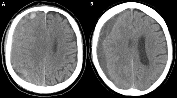 Case illustration of clinical failure. (A) Preprocedural head CT image in a 74-year-old man with an extensive cardiovascular history (receiving aspirin and clopidogrel) and stage IV lung cancer shows a right-sided isodense subacute subdural hematoma. The patient was initially managed conservatively and eventually offered middle meningeal artery embolization because of persistent headaches, which was uneventful. The patient subsequently returned from rehabilitation after 4 weeks. (B) Head CT image in the same patient shows changes in hematoma density and decreased size. Despite these radiologic changes, the patient underwent subsequent rescue craniotomy because of progression of headaches.