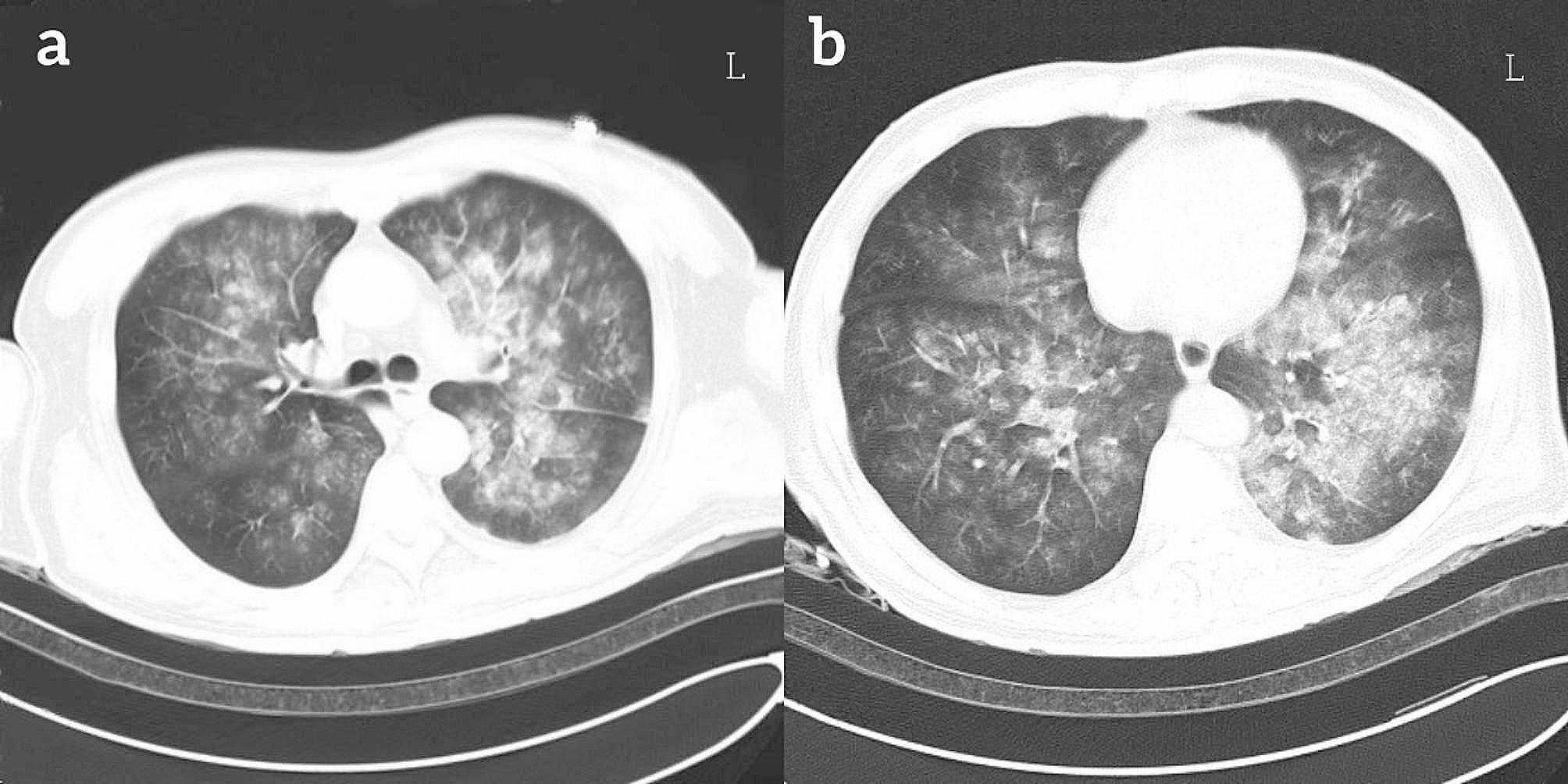 Axillary Vein As An Alternative Venous Access Site For Vv-ecmo 