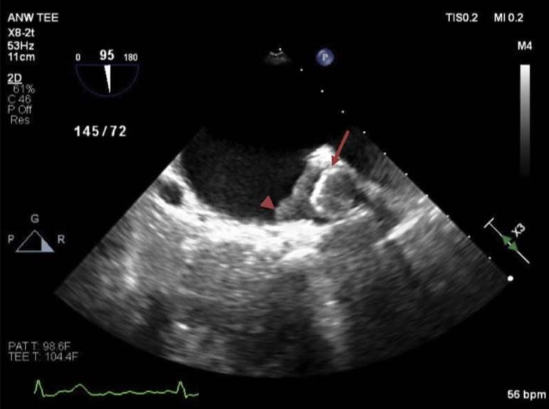 Transesophageal Echocardiography To Diagnose Watchman Device Infection Pmc