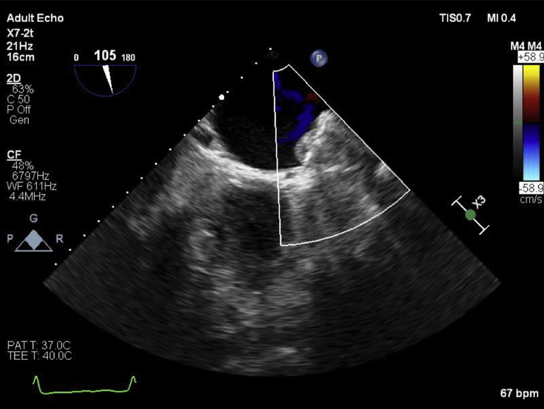 Transesophageal Echocardiography To Diagnose Watchman Device Infection Pmc