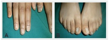 
Figure 3. (A et B) Aspect clinique typique des ongles atteints de
trachyonychie : aspect rugueux, fins, fragiles et dystrophiques de tous les
ongles des mains et des pieds d’une fillette de 6 ans.
