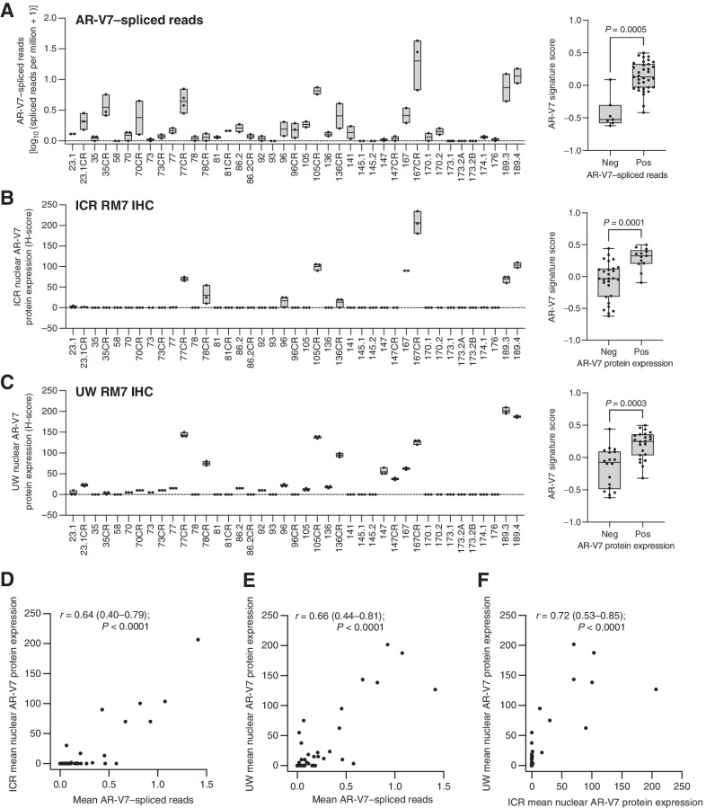 Figure 5. Comparison of AR-V7 IHC assays between laboratories, and with AR-V7 spliced reads from RNA analysis, in the LuCaP series of prostate cancer PDX models. A, For each model in the LuCaP series, the number of read counts corresponding to AR-V7 spliced reads (between exon 3 and cryptic exon 3) was determined from RNA-seq analysis. Spliced reads data are shown as log10 (spliced reads per million + 1). Box shows mean and bars show minimum and maximum values. AR-V7 signature score shown for AR-V7–negative and –positive models determined by AR-V7–spliced reads. Box shows median and interquartile range; bars show minimum and maximum values. Statistical significance between differences were measured by the Welch t test. B–C, For each model in the LuCaP series nuclear AR-V7 staining (H-score) was determined by IHC using RM7 antibody and was performed at the ICR (1 in 500, B) and UW (1 in 50, C). Box shows mean and bars show minimum and maximum values. AR-V7 signature score shown for AR-V7–negative and positive models determined by ICR and UW RM7 IHC. Box shows median and interquartile range; bars show minimum and maximum values. Statistical significance between differences were measured by the Welch t test. D–E, The association between mean AR-V7–spliced reads and mean nuclear AR-V7 staining determined at ICR (D) and UW (E) is shown. Statistical significance between correlations was determined by Spearman rank. F, The association between mean nuclear AR-V7 staining determined at ICR and UW is shown. Statistical significance between correlations was determined by Spearman rank.