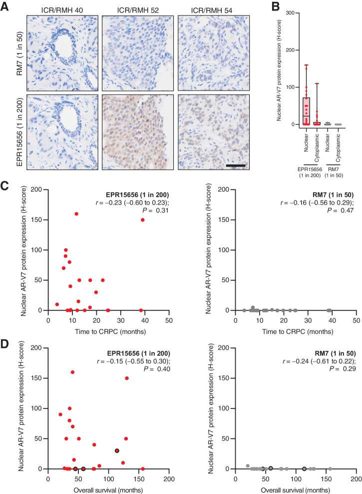 Figure 6. AR-V7 protein quantification by two IHC assays in diagnostic biopsies of prostate cancer patients who received systemic therapy alone. A, Representative micrographs of AR-V7 protein detection by IHC using EPR15656 (Abcam, 1 in 200) and RM7 (RevMAb, 1 in 50) antibodies in three diagnostic CSPC prostate biopsies from patients in the Institute of Cancer Research/Royal Marsden Hospital (ICR/RMH) primary advanced cohort (scale bar: 50 μm). B, Nuclear and cytoplasmic AR-V7 staining (H-score) using EPR15656 (Abcam, 1 in 200, red circles) and RM7 (RevMAb, 1 in 50, gray circles) antibodies was determined. Box shows median and interquartile range; bars show minimum and maximum values. C, Association between nuclear AR-V7 staining (H-score) using EPR15656 (EPR15656, 1 in 200, red circles) and RM7 (RevMAb, 1 in 50, gray circles) antibodies and time to CRPC, months) from diagnosis is shown. Statistical significance between correlations were determined by Spearman rank. D, Association between nuclear AR-V7 staining (H-score) using EPR15656 (EPR15656, 1 in 200, red circles) and RM7 (RevMAb, 1 in 50, gray circles) antibodies and overall survival (months) from diagnosis is shown. Three patients remain alive at last follow-up (black circle outline). Statistical significance between correlations was determined by Spearman rank.