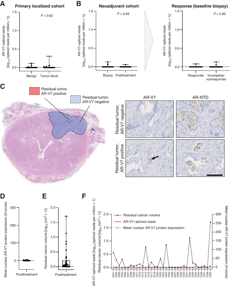 Figure 7. AR-V7 quantification in prostate cancer patients who had primary radical prostatectomy or were treated with neoadjuvant ADT plus enzalutamide for locally advanced disease prior to prostatectomy. A, AR-V7–spliced reads [depicted as log10 (spliced reads per million + 1)] from 84 cases treated by radical prostatectomy. The red dot indicates the only case that received short-course neoadjuvant bicalutamide. Box shows median and interquartile range; bars show minimum and maximum values. Statistical significance between differences were measured by the Mann–Whitney test. B, AR-V7–spliced reads [depicted as log10 (spliced reads per million + 1)] from 37 cases treated with six months of neoadjuvant ADT plus enzalutamide prior to radical prostatectomy. Left, comparison of AR-V7 spliced reads from baseline biopsy and posttreatment. Right, stratification of baseline biopsies based on pathologic outcome of responder (n = 15) or incomplete/nonresponder (n = 22). C, Left, whole-slide imaging of a radical prostatectomy specimen from a representative incomplete/nonresponder; region of residual tumor is marked by a dotted line. Serial whole-slide section of AR-V7 staining using the RM7 (RevMAb, 1 in 100) antibody to identify regions of residual tumors that are AR-V7 positive (small foci marked in red) or AR-V7 negative (larger region marked in blue). Right, representative micrographs of AR-V7 and AR N-terminal (AR-NTD) IHC of residual tumor from serial sections (scale bar: 200 μm). D, Distribution of H-scores for AR-V7 IHC from posttreatment specimens with residual tumor (n = 34). E, Distribution of residual cancer volumes for each patient receiving six months of neoadjuvant ADT plus enzalutamide prior to radical prostatectomy. Data, log10 (cm3 + 1). F, Overlay of data presented in B, D, and E, displayed by patient with all data available (n = 34). AR-V7–spliced read abundance and residual cancer volume are plotted on the left Y axis, and mean H-score for nuclear AR-V7 staining is plotted on the right Y axis.