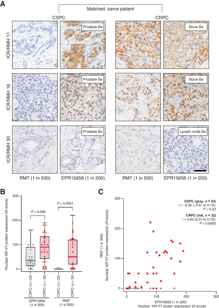 Figure 3. AR-V7 protein quantification by two IHC assays in matched, same patient, castration-sensitive and castration-resistant prostate cancer tissue biopsies. A, Representative micrographs of AR-V7 protein detection by IHC using EPR15656 (Abcam, 1 in 200) and RM7 (RevMAb, 1 in 500) antibodies in three patients with matched CSPC and CRPC tissue biopsies from the Institute of Cancer Research/Royal Marsden Hospital (ICR/RMH) matched CSPC and CRPC cohort (scale bar: 50 μm). Prostate, lymph node, and bone biopsies (Bx) are shown. B, Nuclear AR-V7 staining (H-score) using EPR15656 (23 CSPC and 32 CRPC) and RM7 (26 CSPC and 32 CRPC) antibodies was determined. Box shows median and interquartile range; bars show minimum and maximum values. Statistical significance between differences was measured by Mann–Whitney tests. C, Nuclear AR-V7 staining (H-score) for EPR15656 and RM7 in the same 23 CSPC (gray) and 32 CRPC (red) biopsies is shown. Statistical significance between correlations was determined by Spearman rank.