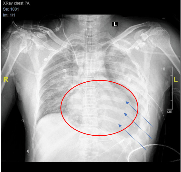 A case of traumatic diaphragm rupture a differential diagnosis not to