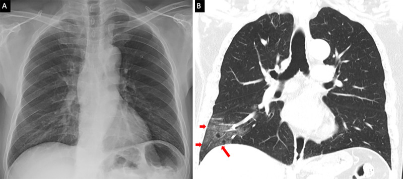 A comparison of, A, chest radiograph and, B, thorax CT coronal image. The ground-glass opacities in the right lower lobe periphery on the CT (red arrows) are not visible on the chest radiograph, which was taken within 1 hour of the CT.
