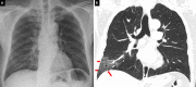 A comparison of, A, chest radiograph and, B, thorax CT coronal image. The ground-glass opacities in the right lower lobe periphery on the CT (red arrows) are not visible on the chest radiograph, which was taken within 1 hour of the CT.
