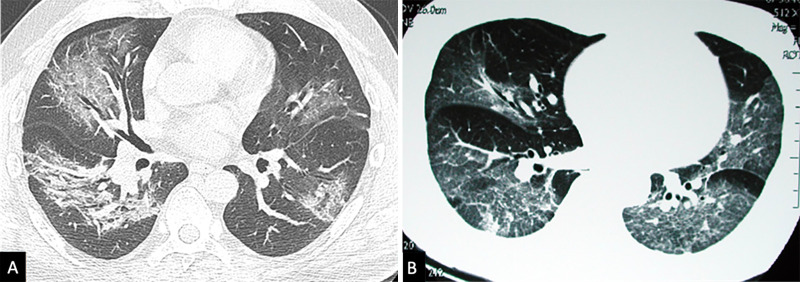 Axial CT images show, A, case of COVID-19 and, B, a case of severe acute respiratory syndrome from 2003. Both cases demonstrate similar predominantly ground-glass opacities affecting both lungs.