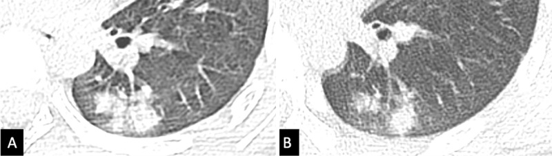 A 10-year-old asymptomatic male child with confirmed COVID-19 infection, who had traveled to Wuhan, China, with his family. A, Image shows the initial CT scan at time of presentation, with consolidation in the left lower lobe apical segment. B, Image shows mild improvement in the lung consolidation 4 days later.