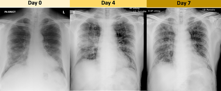 Chest radiographs in an older male patient from Wuhan, China, who traveled to Hong Kong, China. These are three chest radiographs selected out of the daily chest radiographs acquired in this patient. The consolidation in the right lower zone on day 0 persisted into day 4 with new consolidative changes in the right midzone periphery and perihilar region. This midzone change improved on the day 7 radiograph.