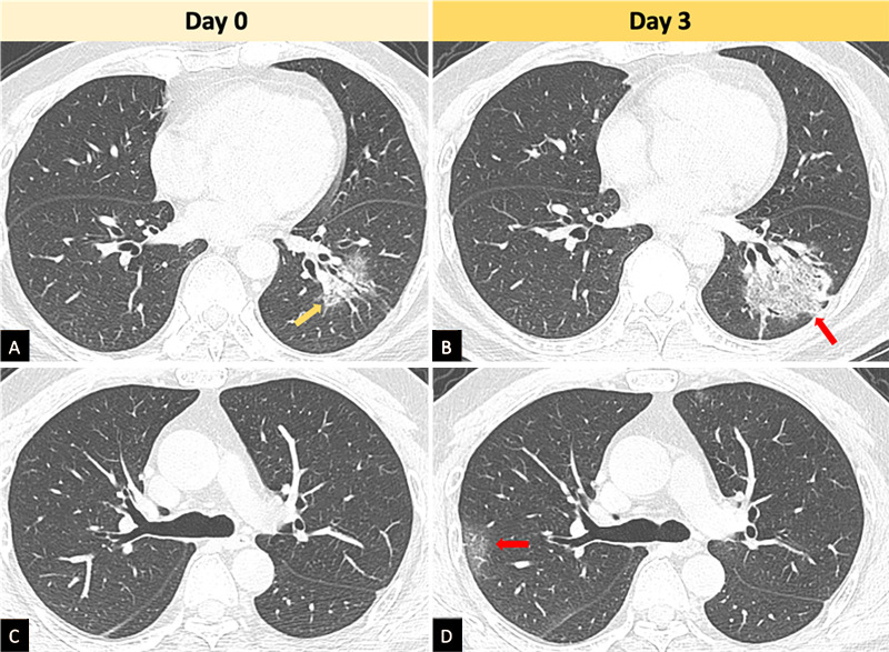 Chest CT follow-up in a patient who had no previous travel to Wuhan, China, but had contact with a patient with confirmed COVID-19 infection. Axial slices from day 0 of presentation to the hospital shows ground-glass opacities in the left lower lobe (arrow, A), but not in the right upper lobe (C). Subsequently, 3 days later, the follow-up CT showed an increase in the ground-glass changes with some peripheral consolidation (reversed halo, arrow, B) and new ground-glass opacities in the right upper lobe periphery (arrow, D).