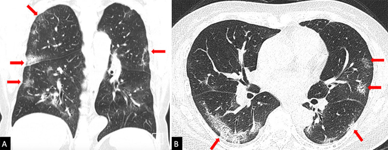 A 65-year-old female patient who had traveled to Wuhan, China, subsequently developing fever and cough 5 days after arrival. She returned to Shenzhen, China, and underwent this chest CT examination 7 days after symptom onset. A, Coronal and, B, axial CT images show a mixture of ground glass and consolidation in the periphery of the lungs (red arrows), with the absence of pleural effusions, which was the typical appearance of patients with confirmed COVID-19 infection.