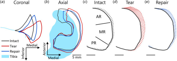 Representative example of meniscus displacements at high load with each treatment. (a) Midcoronal outlines show that the tear allowed the meniscus to be pushed out of the joint space passed the edge of the tibia, while the repair partially restored the meniscus position toward the intact case. (b) Axial plane outlines show the same, while also illustrating that the anterior part of the meniscus is displaced more than the posterior. (c) Region labels (AR, MR, and PR) for a representative sample of displacements from intact low load to treatment high load for (c) intact, (d) tear, and (e) repair treatment. The anterior region of the meniscus had large medial displacements following tear that were reduced with repair. The MR had moderate displacements that increase with tear and moved posteriorly, while the PR had small displacements.