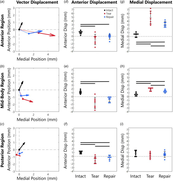 Meniscus position at high load (arrow head) and low load (arrow origin) averaged in the (a) anterior region (AR), (b)midbody region (MR), and (c) posterior region (PR). Arrowhead size is related to displacement distance. The dashed lines in (a–c) show displacement from the intact low load position to the tear and repair low load initial positions (additional information provided in Supplemental Materials on the ASME Digital Collection). The total displacement vector for each case, intact low load to intact/tear/repair high load, is decomposed into (d–f) anterior displacement components and (g–i) medial displacement components. All meniscus regions displaced posteriorly after the tear (d–f) and the AR and MR displaced medially (g–i). The repair generally reduced the large displacements induced by the tear but did not completely restore the intact displacements.