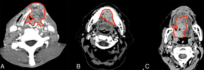 Example segmentation at axial postcontrast CT imaging. A, Squamous cell carcinoma of supraglottic larynx with anterior extralaryngeal extension. B, Left floor of mouth squamous cell carcinoma invading the genioglossus muscle and crossing the midline. C, Oropharynx squamous cell carcinoma including the base of the tongue with extension to the oral tongue.