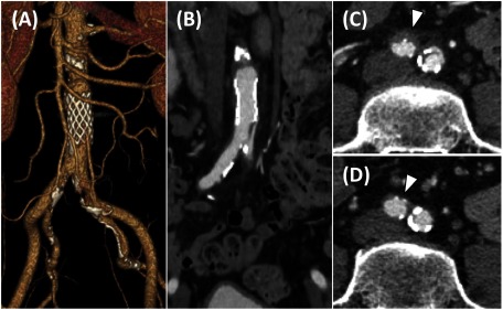 Fig. 3 Postoperative contrast computed tomography scan of the abdominal aorta.