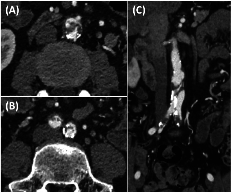 Fig. 1 Preoperative contrast computed tomography of the abdominal aorta.