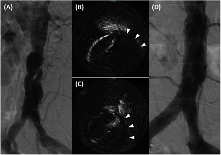 Fig. 2 The catheterization and endovascular therapy.