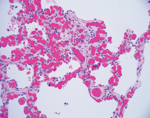 Histologic image (hematoxylin and eosin stain, 200×magnification) of alveolar septa shows a vascular congestion and hemangiomatosis-like lesion. Notice the absence of acute lung injury, inflammation, and hyaline membrane formation. While originally described in the acute setting, this vascular congestion and hemangiomatosis-like lesion was identified in an explanted lung approximately 4 months after acute COVID-19 pneumonia.