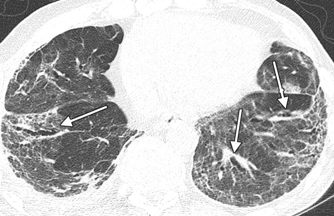 Image in a 74-year-old man with history of SARS-CoV-2 infection. Unenhanced axial CT image 5 months after acute infection shows bilateral residual peripheral ground-glass opacity and bandlike opacities. Varicoid traction bronchiectasis and bronchiolectasis occurs within areas of reticulation and architectural distortion, in keeping with fibrosis (arrows).