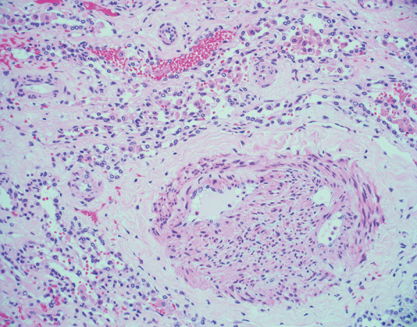 Histologic image (hematoxylin and eosin stain, 200× magnification) shows recanalized pulmonary arteriole with neolumen formation. This finding was observed in an explanted lung 4 months after acute COVID-19.