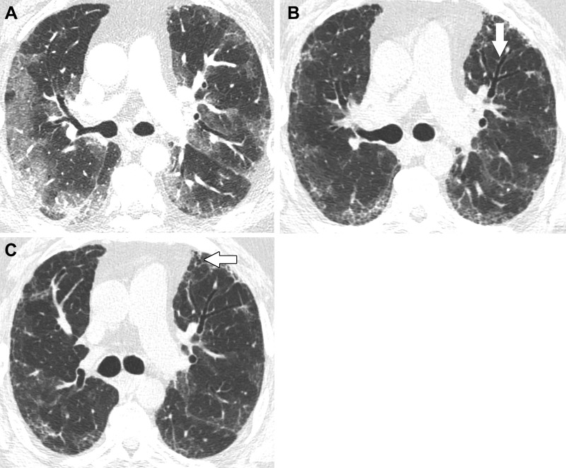 Images in a 57-year-old man with fibrosis resulting from SARS-CoV-2 infection. (A) Contrast-enhanced axial CT image at presentation shows peripheral predominant ground-glass opacity with a small amount of consolidation. (B) Unenhanced axial CT image 3 months later shows marked clearing of ground-glass opacity but development of reticulation and mild bronchial dilation (arrow). (C) Unenhanced axial CT image 6 months after infection shows further decrease of ground-glass opacity and a lesser extent of reticulation. The area of bronchial dilation in the left upper lobe has resolved, although there is a small peripheral area of traction bronchiectasis (arrow).