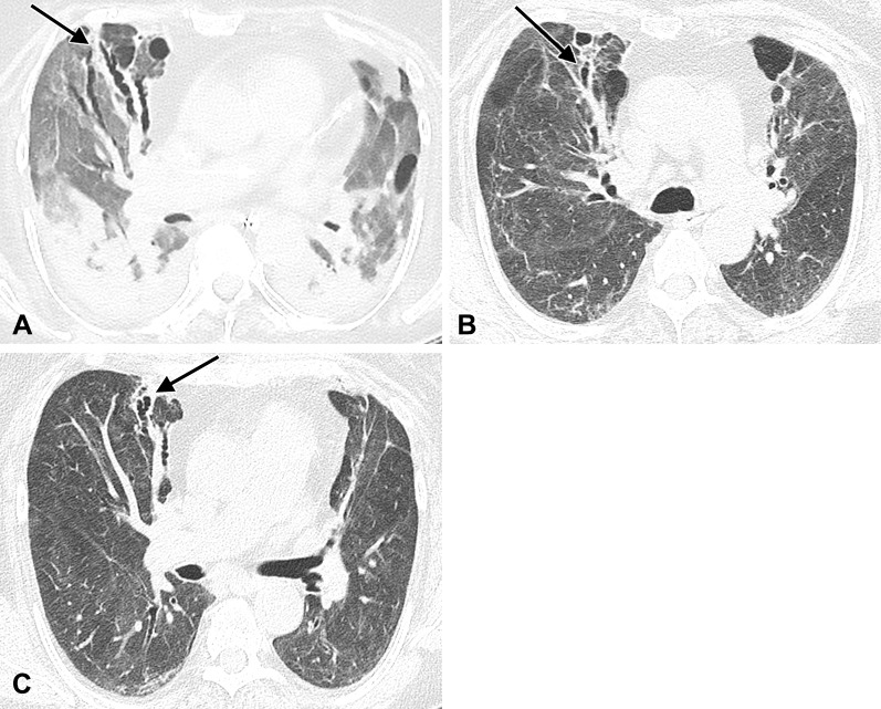 Images in a 77-year-old woman hospitalized with acute respiratory distress syndrome resulting from SARS-CoV-2 infection. (A) Unenhanced axial CT image during acute infection and mechanical ventilation shows typical findings of alveolar damage, with dependent consolidation and ground-glass opacity throughout the remainder of the lungs. Varicoid bronchial dilation and an air cyst have developed within the anterior right lung (arrow). (B, C) Unenhanced axial CT images 10 months after infection show anterior predominant varicoid bronchiectasis (arrows), slightly decreased in severity and accompanied by reticulation and architectural distortion. A background of residual ground-glass opacity, peripheral parenchymal bands, and reticulation is also present.