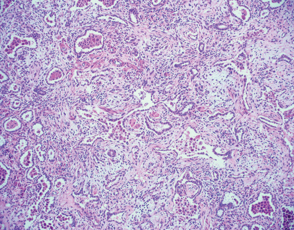 Histologic image (hematoxylin and eosin stain, 100× magnification) of pulmonary parenchyma shows organizing diffuse alveolar damage. There are residual alveolar spaces with marked increase in the interstitium by cellular fibroblastic proliferations. Some fibroblastic proliferations are also likely within alveoli. Type 2 pneumocyte hyperplasia is present. These findings were observed in an explanted lung approximately 6 months after acute COVID-19.