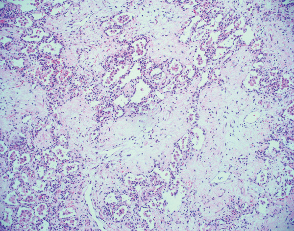 Histologic image (hematoxylin and eosin stain, 100× magnification) shows diffuse pulmonary fibrosis in an explanted lung 6 months after acute COVID-19. There is deposition of paucicellular, eosinophilic material within the pulmonary interstitium. Some residual alveolar spaces are present but appear compressed. These findings have been previously described in explanted lungs and likely represent the fibrotic phase of diffuse alveolar damage.