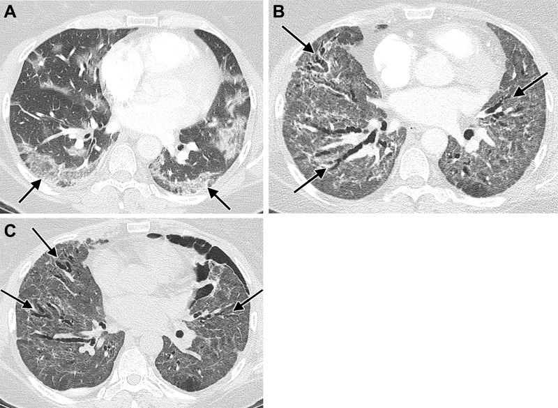 Images in a 51-year-old woman with history of SARS-CoV-2 infection, noninvasive positive pressure ventilation, and chronic dyspnea requiring home oxygen therapy. (A) Contrast-enhanced axial CT image during acute infection shows bilateral ground-glass opacity with peripheral predominance (arrows). (B) Contrast-enhanced axial CT image after discharge, 2 months after presentation, shows diffuse ground-glass opacity and architectural distortion with diffuse varicoid bronchial dilation (arrows). (C) Unenhanced axial CT image 6 months after presentation shows decrease in ground-glass opacity but persistent diffuse varicoid bronchiectasis (arrows); a small left pneumothorax is also present.