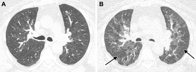 Images in a 58-year-old woman with history of SARS-CoV-2 infection, ongoing dyspnea after infection, and history of sleep apnea. (A) Unenhanced axial CT image at full inspiration performed 2 years after acute infection shows subtle diffuse mosaic attenuation. (B) Paired expiratory axial CT image shows extensive lobular and regional low attenuation indicative of air trapping (arrows).