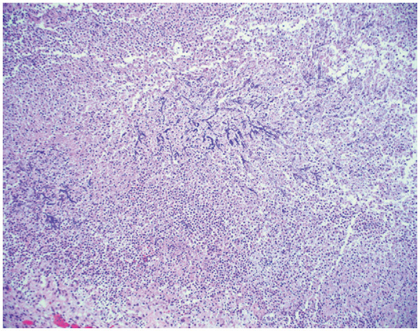 Histologic image (hematoxylin and eosin stain, 100× magnification) shows numerous fungal hyphae with acute angle branching and septations. These fungal hyphae are favored to represent Aspergillus, but no culture data were available. The fungi are seen in a background of marked neutrophilia, consistent with a necrotizing abscess.