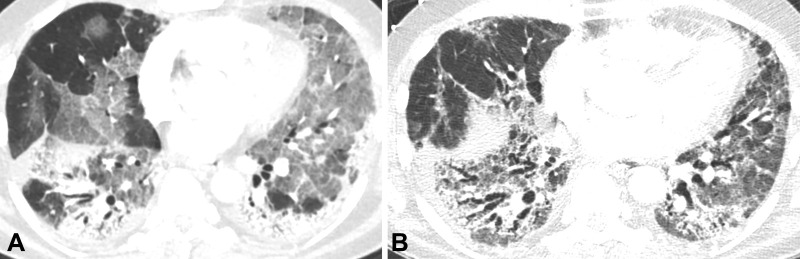 Images in a 56-year-old man with fibrosis resulting from SARS-CoV-2 infection. (A) Contrast-enhanced axial CT image early during infection shows extensive ground-glass opacity with posterior and peripheral predominant consolidation and some areas of crazy paving. (B) Unenhanced axial CT image from 10 months later shows lower lobe predominant reticulation, traction bronchiectasis, and ground-glass opacity with lower lobe volume loss.