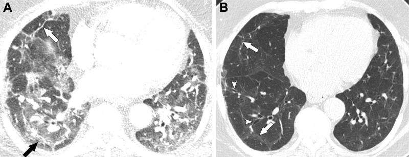 Images in a 63-year-old man with residual lung abnormalities from SARS-CoV-2 infection. (A) Contrast-enhanced axial CT image at presentation shows peripheral and peribronchial ground-glass opacity and consolidation along with perilobular thickening (arrows). (B) Unenhanced axial CT image 1 year later shows patchy residual ground-glass opacity, persistent perilobular thickening (arrows), and mild bronchial dilation (arrowheads) in areas of ground-glass opacity.