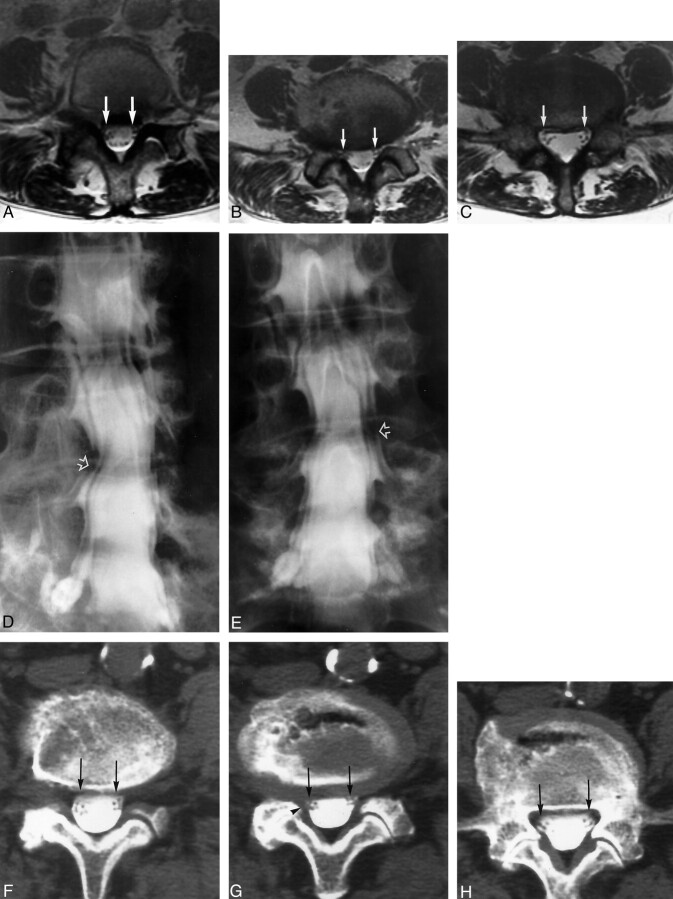 Lumbar Root Compression in the Lateral Recess: MR Imaging, Conventional ...