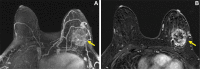 Images in a 34-year-old woman without family history of breast cancer
with newly diagnosed left breast cancer manifesting as a palpable lump. MRI
performed for extent of disease demonstrates heterogeneous fibroglandular
tissue. (A) Axial, subtracted, postcontrast maximum intensity projection MRI
scan shows minimal background parenchymal enhancement (BPE) and a mass in
the left lateral breast (arrow). (B) Postcontrast, T1-weighted subtracted
axial MRI scan with the section centered at the level of the left breast
mass shows the enhancing irregular mass (arrow) that was subsequently
biopsied yielding poorly differentiated invasive ductal carcinoma. Studies
show mixed results regarding the association between BPE and breast cancer
in patients at average risk (ie, without family history of breast cancer or
known deleterious genetic alteration).