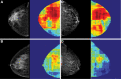 (A, B) Mammograms (left) of heterogeneously dense breasts are analyzed
in terms of a convolutional neural network–based pixel-wise risk
model (right), which identifies the breast at higher risk for cancer (A) by
having more substantial areas in red, corresponding to features that overlap
with patients who developed breast cancer, as opposed to normal (blue)
areas. (C, D) Similarly, among two breasts with scattered areas of
fibroglandular density at mammography (left), the breast at higher risk for
cancer (C) is identified by having more substantial red areas (right).
(Reprinted, with permission, from reference 48.)