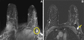 Images in a 46-year-old woman at high risk for breast cancer due to
strong family history (calculated lifetime risk of 33%). Screening MRI
demonstrated extreme fibroglandular tissue. (A) Axial, subtracted,
postcontrast maximum intensity projection MRI scan shows moderate background
parenchymal enhancement (BPE) and a mass in the left axillary tail (circle).
(B) Postcontrast, T1-weighted subtracted axial MRI scan with the section
centered at the level of the left breast mass shows the enhancing irregular
mass (arrow) that was subsequently biopsied yielding moderately
differentiated carcinoma with mixed ductal and lobular features.A higher BPE
level has been associated with risk of breast cancer in women at high
risk.