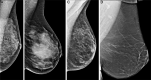  Mediolateral oblique digital mammograms with negative findings at
screening in women with (A) high density and high complexity, (B) high
density and low complexity, (C) low density and high complexity, and (D) low
density and low complexity. Breast density is associated with higher risk
for developing breast cancer. In addition, breasts with more complex
parenchymal patterns are at higher risk for breast cancer. These parenchymal
patterns were assessed with handcrafted radiomic features to develop an
overall complexity score. (Reprinted, with permission, from reference
39.)