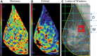 (A, B) Digital mammographic heat maps show radiomic feature
calculations in the breast area; for example, skewness (A) (a gray-scale
feature) and entropy (B) (a co-occurrence feature). (C) To capture
heterogeneities in breast texture in the breast area (dashed yellow line),
radiomic features can be calculated in multiple windows whereby each window
(example in red, with the length of each side defined as W) is centered on a
lattice point (blue circle) and green lines define the lattice grid, with
the spacing between lattice points defined as D. (Reprinted, with
permission, from reference 38.)