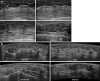 (A) Handheld breast US and (B) automated breast US images show
qualitative four-category classification of the glandular tissue component
in women with dense breasts. When distribution of the glandular tissue
component in the breast is not uniform, the dominant pattern seen in at
least two quadrants, or in the area of densest fibroglandular tissue, is
subjectively determined to be the glandular tissue component.