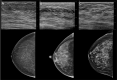 Top: Classification of tissue composition at breast US according to
the Breast Imaging Reporting and Data System, 5th edition. Representative US
images show (A) homogeneous background echotexture (fat), (B) homogeneous
background echotexture (fibroglandular), and (C) heterogeneous background
echotexture. Bottom: Corresponding craniocaudal mammograms show (A) almost
entirely fat, (B) extremely dense, and (C) heterogeneously dense or
scattered fibroglandular tissue at mammography.