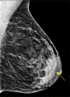 Mediolateral oblique screening digital mammogram in a 56-year-old
woman shows dense tissue in the anterior subareolar area of the breast
(arrow). If assigned a Breast Imaging Reporting and Data System (BI-RADS)
breast density based on the 4th edition, the percent density in the breast
would be less than 51% and, therefore, would be considered category 2 or
“scattered fibroglandular densities.” However, if classified
according to the 5th Edition of BI-RADS for density, the dense tissue in the
anterior breast could “mask” or obscure a lesion, causing a
reduction in detection sensitivity. Based on the density definitions in the
5th Edition, this breast would be considered “heterogeneously dense,
which may obscure detection of small masses.”