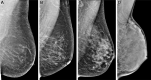 Mediolateral oblique digital mammograms illustrating the four
categories of visually assessed breast density according to the 5th edition
of the Breast Imaging Reporting and Data System show (A) breast that is
almost entirely fatty; (B) breast with scattered areas of fibroglandular
density; (C) breast that is heterogeneously dense, which may obscure
detection of small masses; and (D) breast that is extremely dense, which
lowers the sensitivity of mammography. Of note, with increasing higher
density, there is a higher risk of breast cancer.