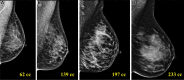 Mediolateral oblique digital mammograms in four different women show
effectively equivalent volumetric percent density (approximately 25%) but
broad variation in the total dense volumes, which range from 62 mL to 233
mL. Volume-based density measures include the total dense volume (sum total
of all fibroglandular pixel volumes) and volumetric percent
density