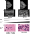 Spectrum of sonographic and histologic appearance of dense breasts at
mammography. (A) Craniocaudal mammograms show extremely dense fibroglandular
tissue in both cases. (B) Breast US images show predominately hyperechoic
fibrous tissue at one end (left) and abundant isoechoic or hypoechoic
glandular tissue at the other end (right) of the spectrum. (C) Histologic
images (hematoxylin-eosin [H&E] stain; original magnification, x200)
show the breast lobules are involuted and replaced by fibrous stroma in the
former case (left), whereas the lobular involution is minimal and the size
and number of acini per lobule is large in the latter case (right). GTC =
glandular tissue component. (Reprinted, with permission, from reference
70.)