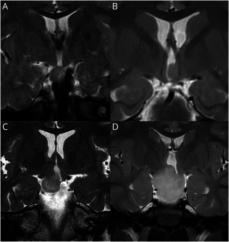 Hypothalamic Hamartomas: Evolving Understanding and Management - PMC