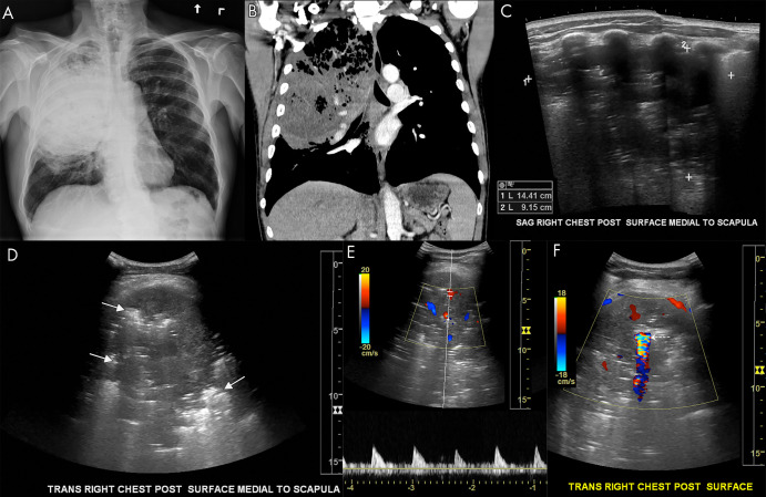 Pulmonary abscess on lung US. A, Anteroposterior chest radiograph and B, coronal chest CT image show a large pulmonary abscess in the right upper lung containing foci of air in a 56-year-old smoker. C, Sagittal and D, transverse grayscale US images demonstrate a large 14-cm abscess. Hyperechoic foci are seen throughout the abscess corresponding to air (arrows, D). E, F, Associated color Doppler images show internal Doppler flow consistent with abscess. There is a large focus of twinkle artifact corresponding to air within the abscess (dashed arrow, F).